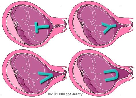 Cerclagem Cervical Uterina