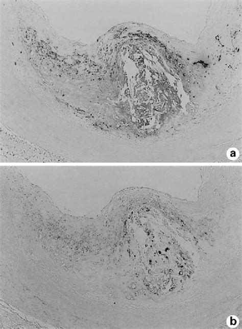 Figure 1 From Soluble Osteopontin And Vascular Calcification In