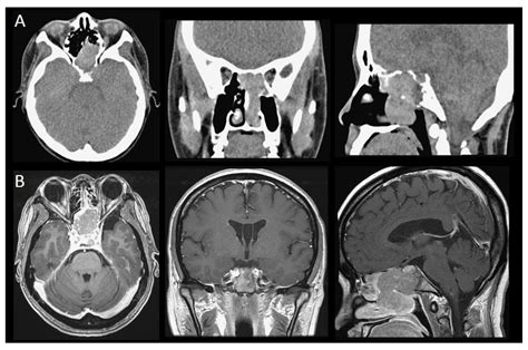 Ethmoid Sinus Malignancy