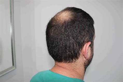 Hlc Hairline Clinic Ankara Dr Ozgur Oztan Fue Vertex