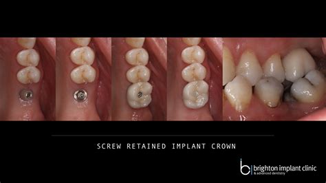 Titanium Implants -Brighton Implant Clinic : Dental Implants