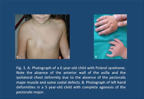 Figure 1 From Us Evaluation Of Poland Syndrome Semantic Scholar