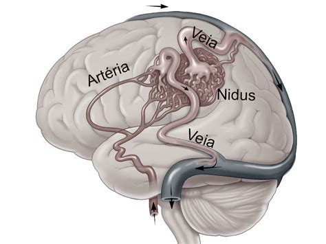 Malforma O Arteriovenosa Neocure