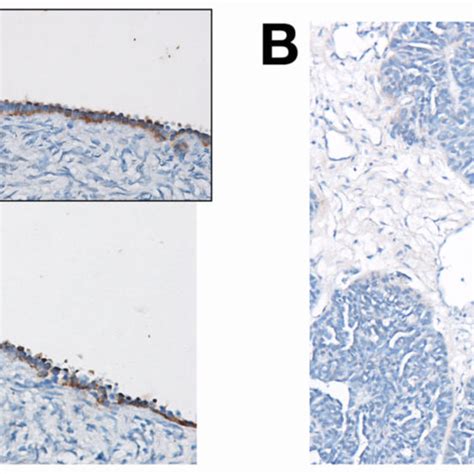 Aldh1a2 Raldh2 Is Expressed In The Normal Ovarian Surface Epithelium