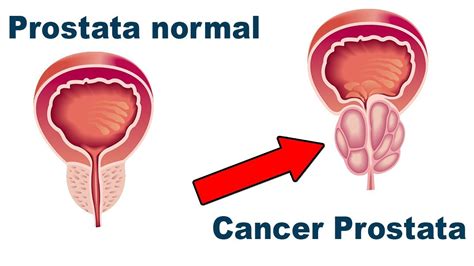 Conoce El C Ncer De Pr Stata Y Lo Que Tu Cuerpo Hace Para Que Lo