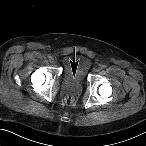 Imaging Of Arthroplasties Improved Image Quality And Lesion Detection