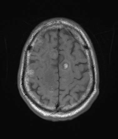 Brain metastasis in malignant melanoma | Radiology Case | Radiopaedia.org