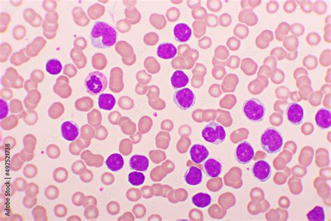 Foto De Picture Of Acute Lymphocytic Leukemia Or All Cells In Blood