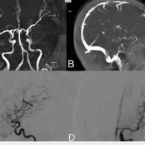 Brain MRA and MRV A: Brain MRA. B: Brain MRV. C: Lateral view DSA. D ...