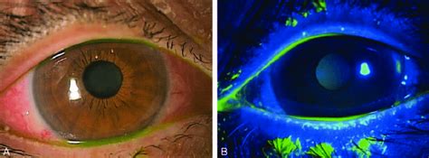 Slit Lamp Photographs Of The Cornea A With Fluorescein Stain B Download Scientific Diagram