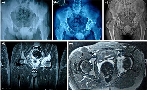 An 18 Year Old Male Patient With A Chondroblastoma Around The Left