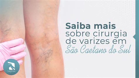 Saiba Mais Sobre Cirurgia De Varizes Em S O Caetano Do Sul