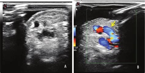 Grayscale A And Color Doppler B Ultrasound Images Showing An