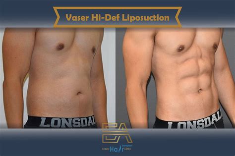 Vaser Hi Def Liposuction Euro Asia Hair Transplant And Beauty Clinic