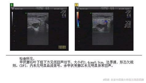 原发性甲状旁腺功能亢进 医联