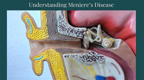 Meniere S Disease Made Simple {explained By A Physical Therapist} Youtube