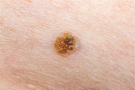 Nevus On Human Skin Stock Image Image Of Epidermal Blemish 94578171