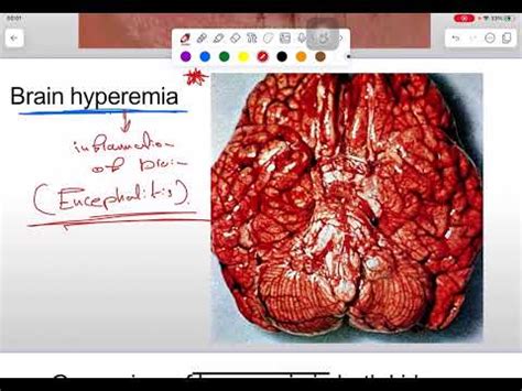 General Pathology Lab Hemodynamics Disorders Part Youtube