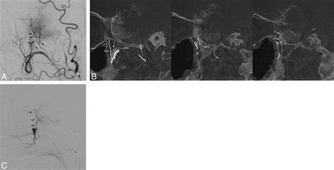 Case Of Parasellar Meningioma Supplied By The Artery Of The Sof A