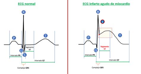 Ecg Del Infarto De Miocardio Explicaci N Con Im Genes