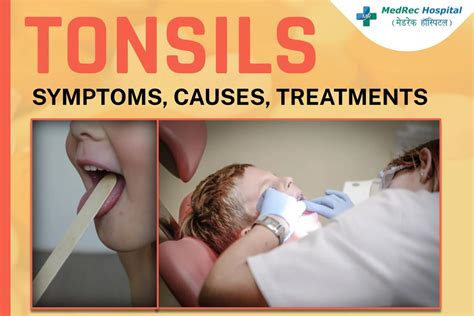 Tonsil Stones: Causes, Symptoms, and Treatment Options