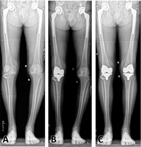 Figure 2 From Total Knee Arthroplasty Function At 25 Years Following