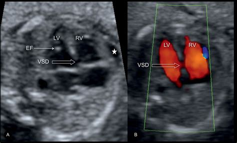 Atrial Ventricular And Atrioventricular Septal Defects Obgyn Key Free