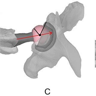 Ct Based Three Dimensional Models Of A Patient With Tha The Acetabular