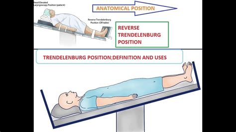 TRENDELENBURG POSITION | REVERSE TRENDELENBURG POSITION | [DEFINITION ...