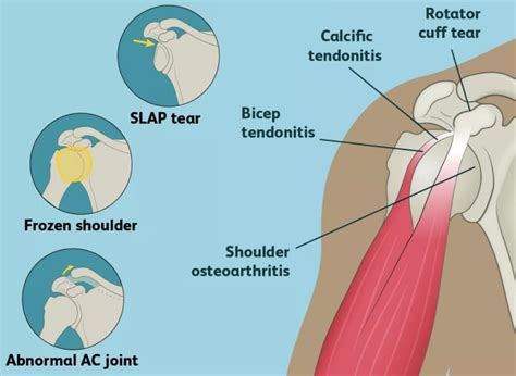 Suffering From Shoulder Pain Self Diagnose With These Easy Tests