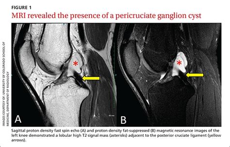 bunka špecifikácia kohút magnetic resonance knee cyst telocvičňa spúšť ...