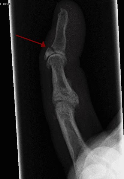 Phalangeal Fracture Management Fixation Teachmesurgery