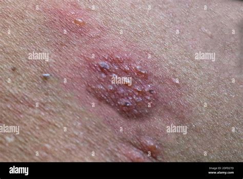 Herpes zoster rash Fotos und Bildmaterial in hoher Auflösung Seite