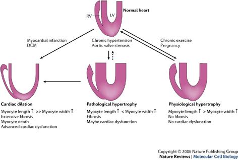 heart hypertrophy issues concentric eccentric | b-reddy.org