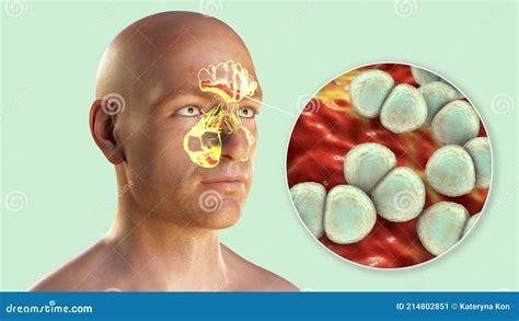 Purulent Inflammation Of Frontal Maxillary And Ethmoid Sinuses And