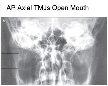 Mandible Tmj Sinuses Flashcards Quizlet