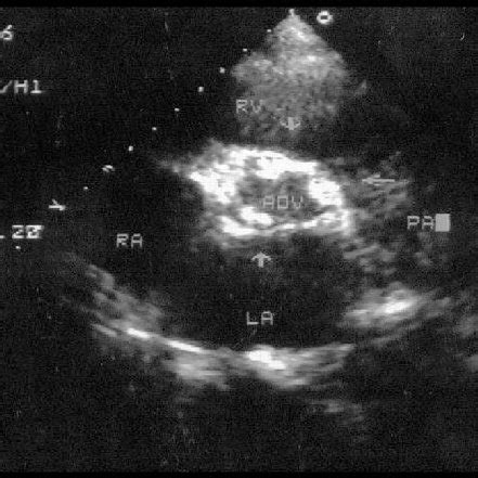 Echocardiogram Showing Multiple Vegetations On Aortic Valve RV Right