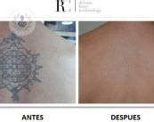 PicoWay la solución para eliminar tatuajes Top Doctors