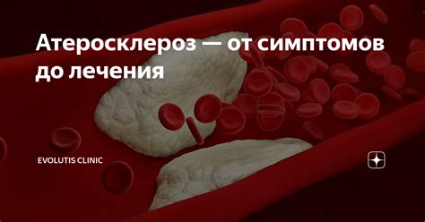 Атеросклероз — от симптомов до лечения | Evolutis Clinic | Дзен