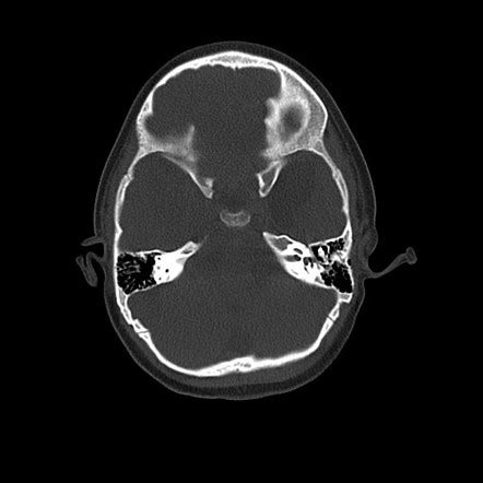 Arachnoid Cyst Middle Cranial Fossa Image Radiopaedia Org