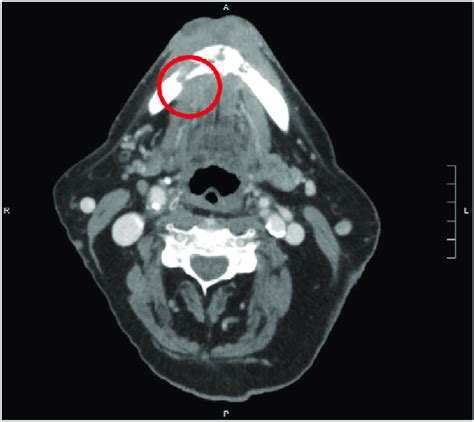 Imaging Of Squamous Cell Carcinoma Computed Tomography With Contrast