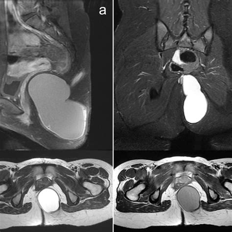 Pilonidal Cyst Mri