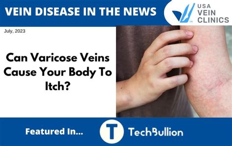 Can Varicose Veins Cause Your Body To Itch Usa Vein Clinics