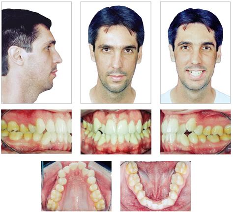 Scielo Brasil Orthodontic Treatment As An Adjunct To Periodontal