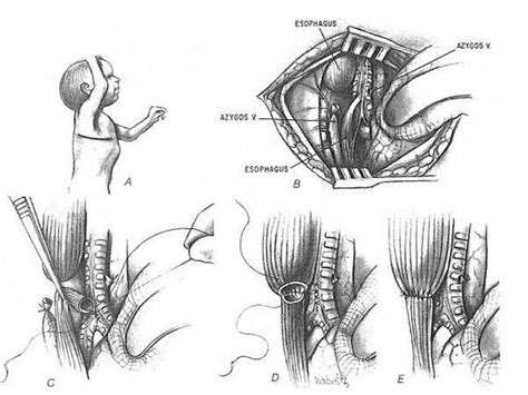 Tracheoesophageal Fistula Ppt