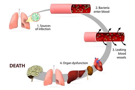 Sepsis: Signs, Symptoms and SOFA | Ausmed