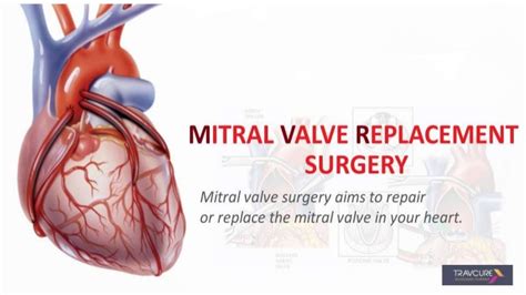 Mitral valve replacement surgery in india