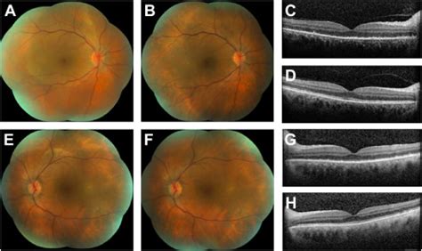 Multimodal Imaging In Infectious Uveitis Advances In Ophthalmology