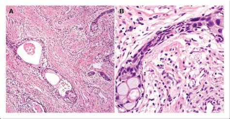 Figure 2 From Comparison Of Subtypes Of Penile Squamous Cell Carcinoma From High And Low