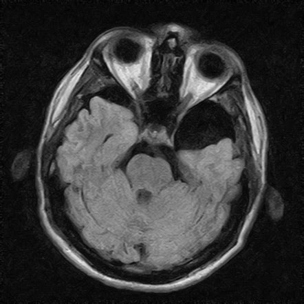 Arachnoid Cyst Middle Cranial Fossa Galassi Type Ii Radiology